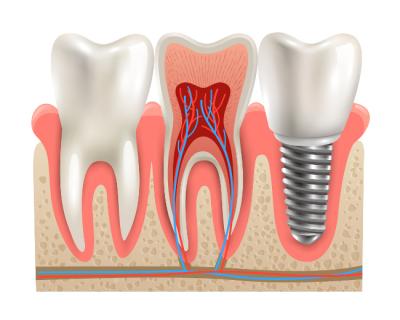 implant dentaire bagnolet